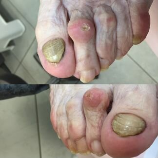 Медицинский педикюр